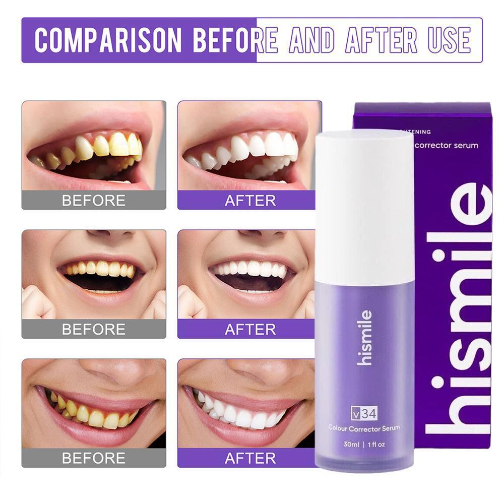 مصحح لون Hismile v34 | احصل على أسنان بيضاء في دقيقتين